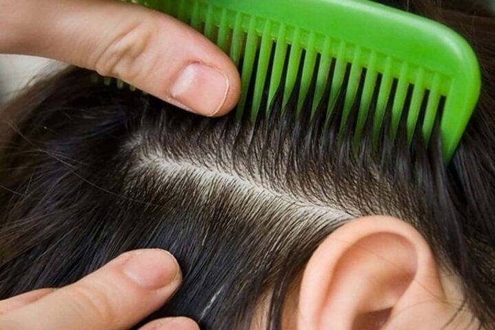 Как вытащить гнид из длинных волос