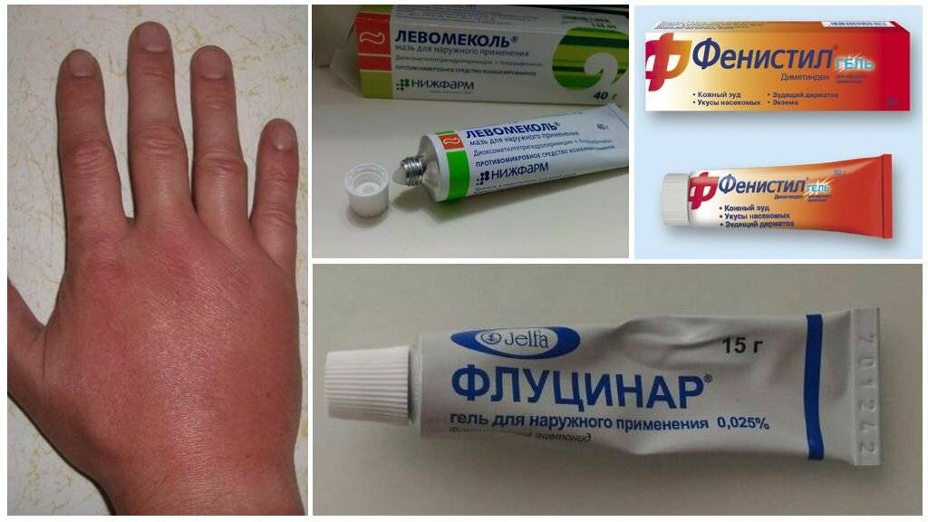 Холодовая аллергия на руках и лице: как она проявляется и как выглядит, лечение реакций на холод, бывают ли они, что это такое, почему чешутся ноги на морозе и что с этим делать