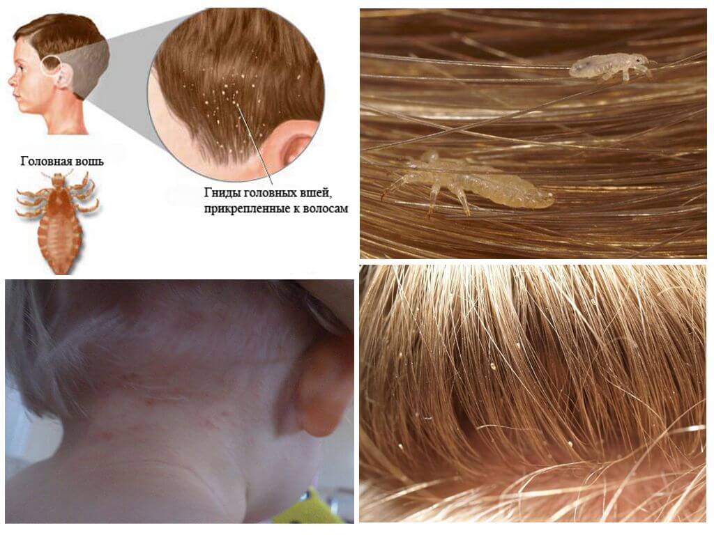 Вши на окрашенных волосах: могут ли появиться или завестись паразиты в волосах, как избавиться от них и народные средства для этого