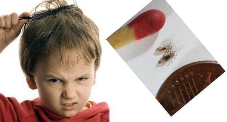 Советы комаровского по лечению вшей у детей
