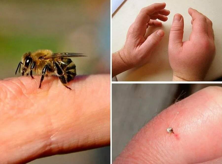 Кто умирает после укуса: оса или пчела. нападение ос и лечение укуса