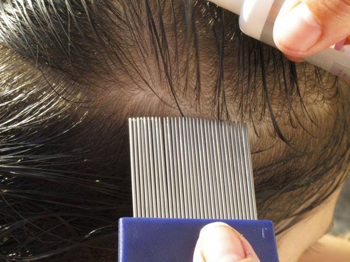 Почему чешется кожа головы после обработки от вшей