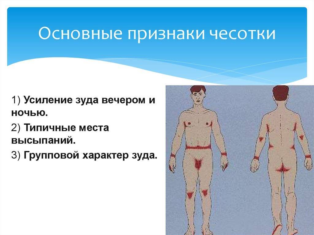 Симптомы и лечение чесотки - medside.ru