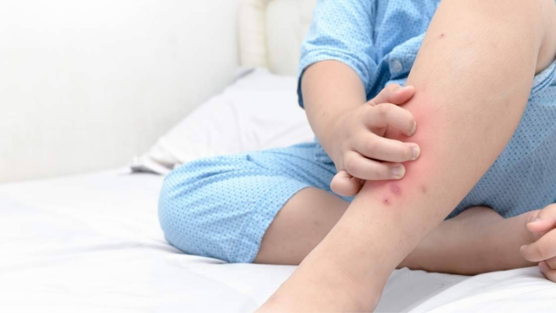 Аллергия на укусы клопов: причины, симптомы, опасность и чем лечить