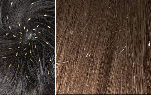 Гниды и вши в волосах: как они выглядят, инкубационный период. как вычесать гниды?