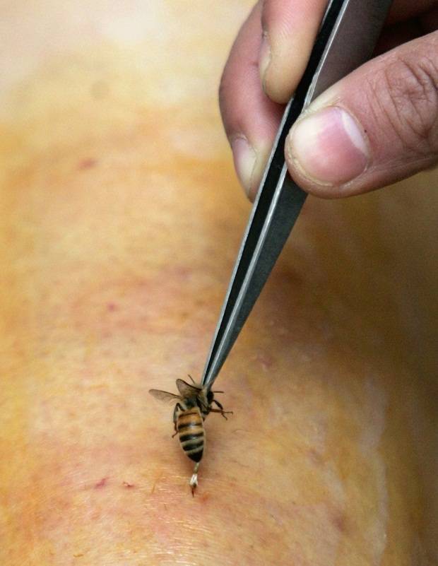 Аллергия на насекомых: чем опасны укусы ос